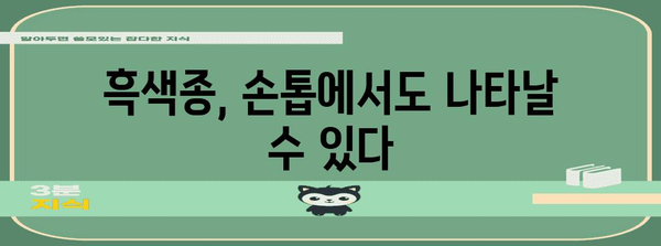 검은 손톱 줄 조심하세요 | 흑색종 원인과 경계해야 할 징후 5가지